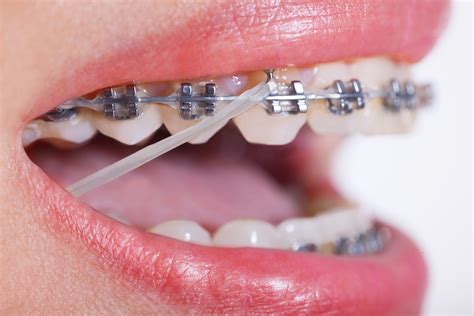 underbite metal bracket rubber bands not braces invisalign|invisalign rubber band replacement.